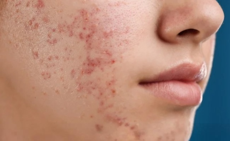 da thâm mụn da tham mun