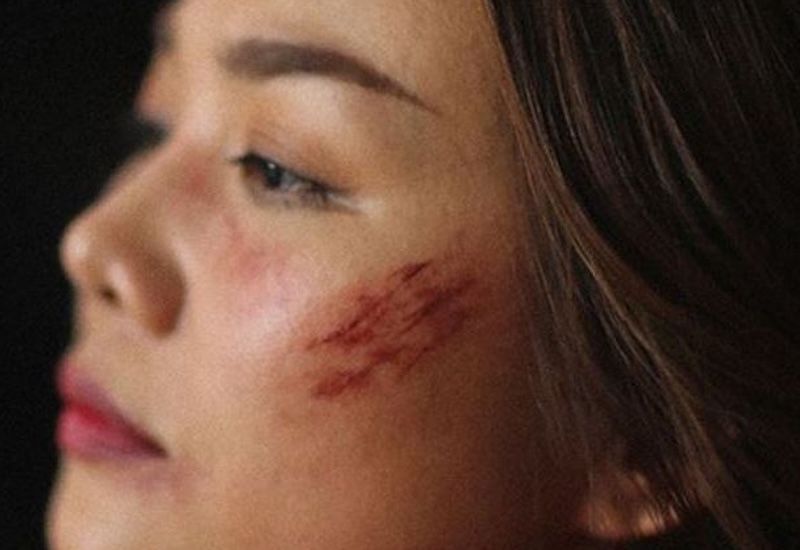 da có vết thương hở da co vet thuong ho