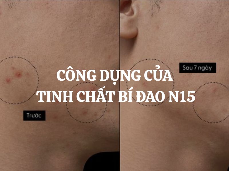 Công dụng của tinh chất bí đao N15 Cocoon: Giải pháp toàn diện cho làn da mụn Công dụng của tinh chất bí đao N15 Cocoon: Giải pháp toàn diện cho làn da mụn