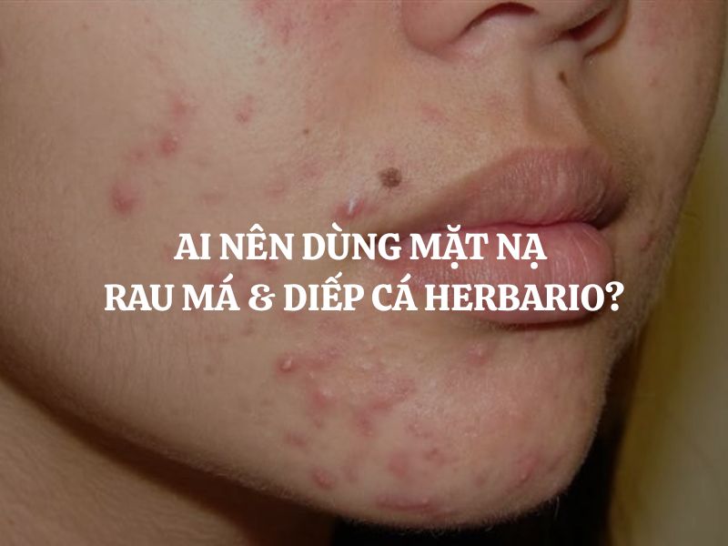 Giải đáp thắc mắc: Ai nên dùng Mặt nạ rau má & diếp cá Herbario sạch mụn thuần chay?