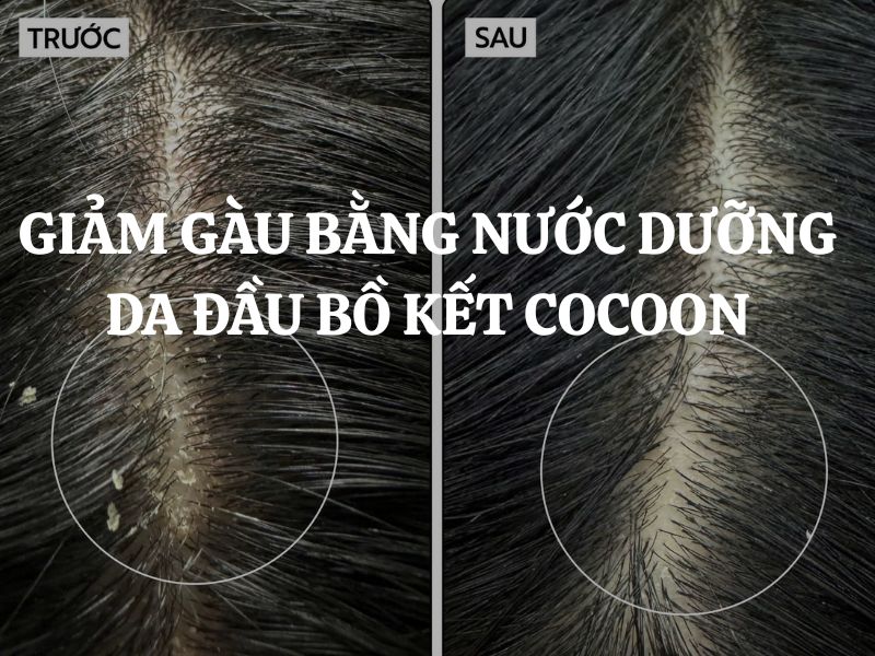 Giảm gàu bằng Nước dưỡng da đầu bồ kết Cocoon có hiệu quả không?